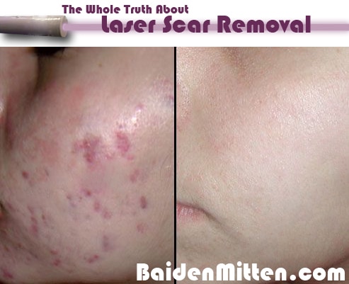 laser scar removal