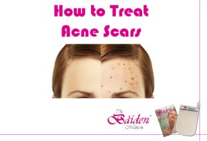 How to treat acne scars