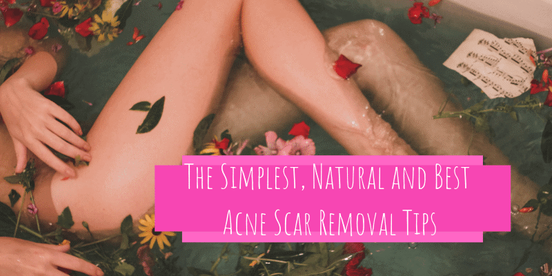 The Simplest and Best Acne Scar Removal Tips