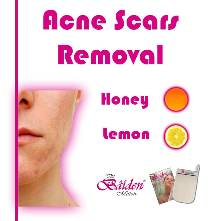 acne scars removal