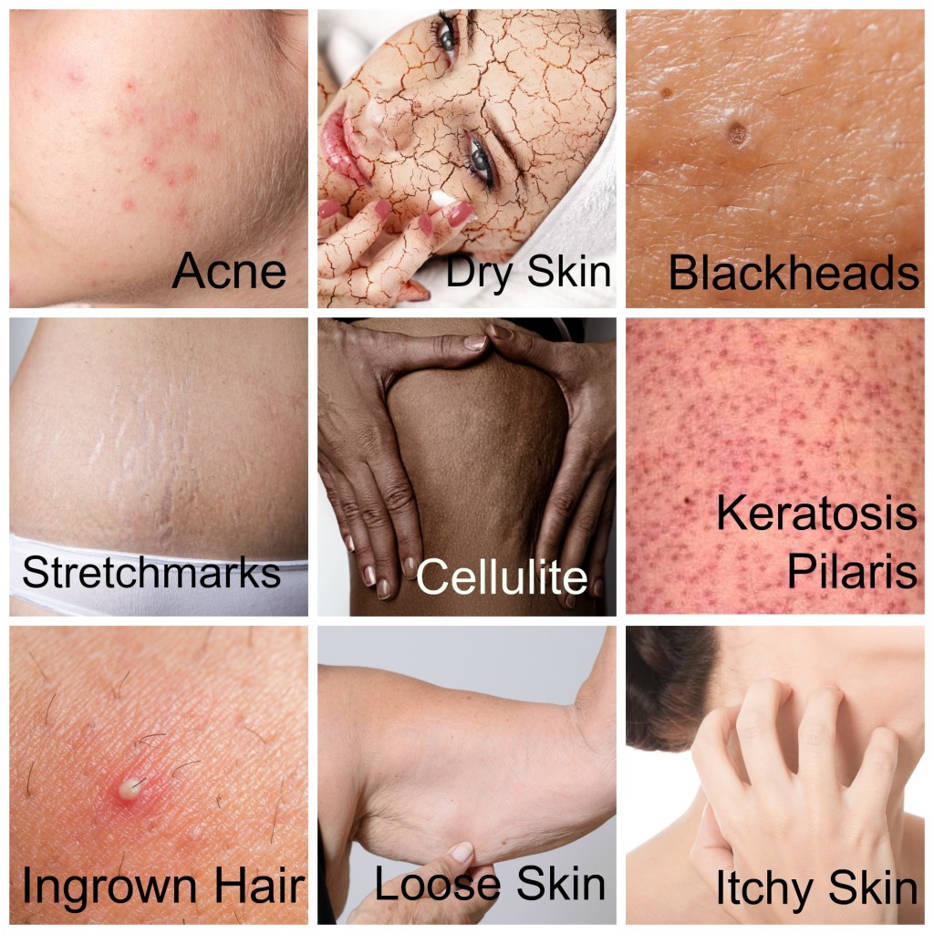 Skin conditions