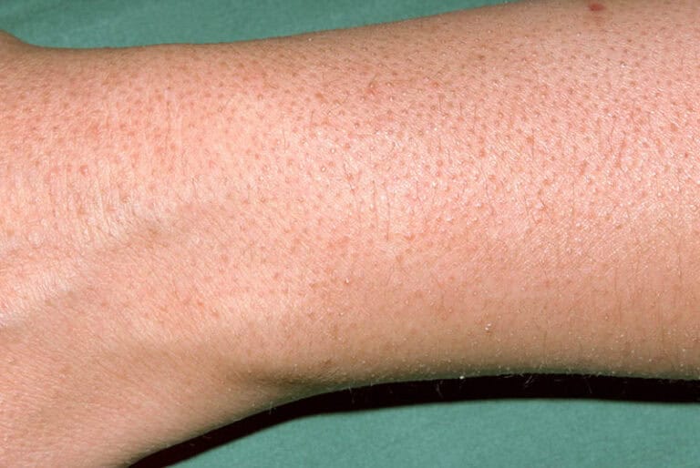 What is Keratosis Pilaris? Baiden Mitten 2024
